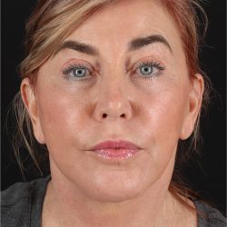 Facelift Before & After Patient #11462