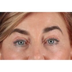 Blepharoplasty (Eyelid Surgery) Before & After Patient #11506