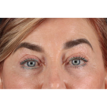 Blepharoplasty (Eyelid Surgery) Before & After Patient #11506