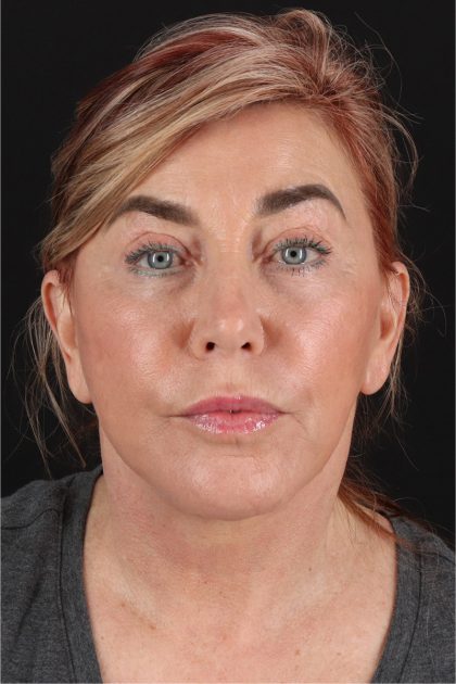 Facelift Before & After Patient #11462