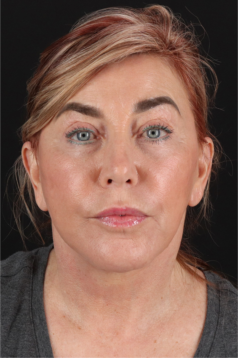 Facelift Before & After Patient #11462