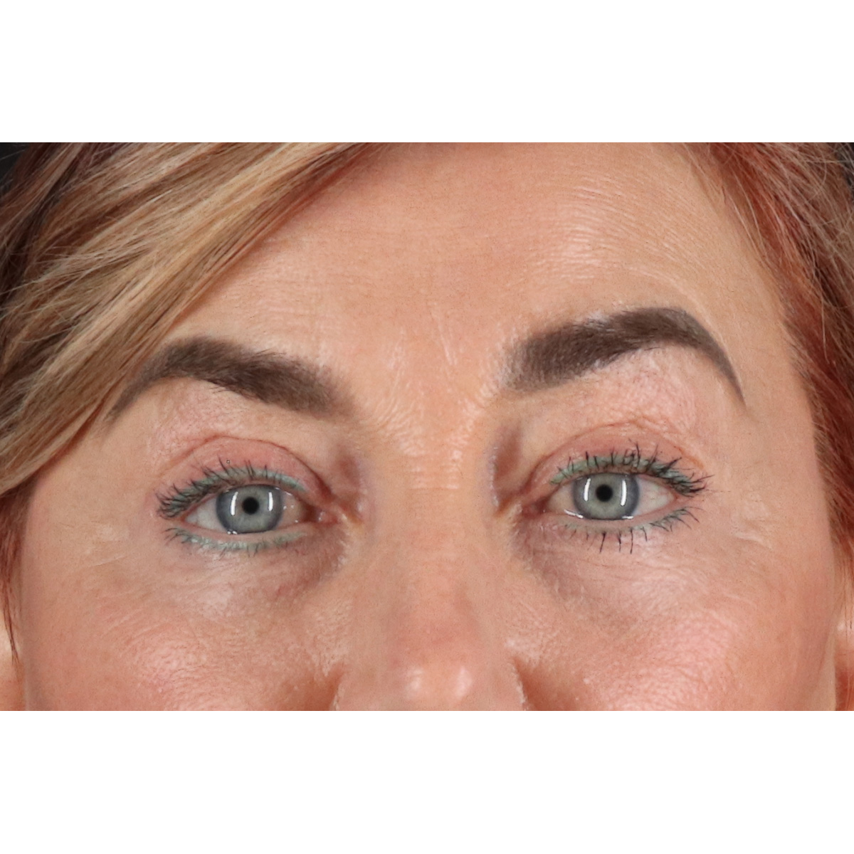Blepharoplasty (Eyelid Surgery) Before & After Patient #11506