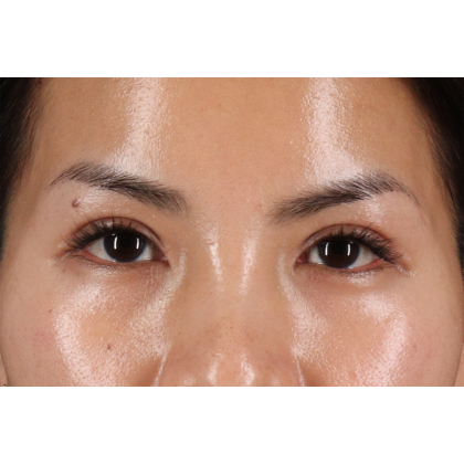 Blepharoplasty (Eyelid Surgery) Before & After Patient #10782