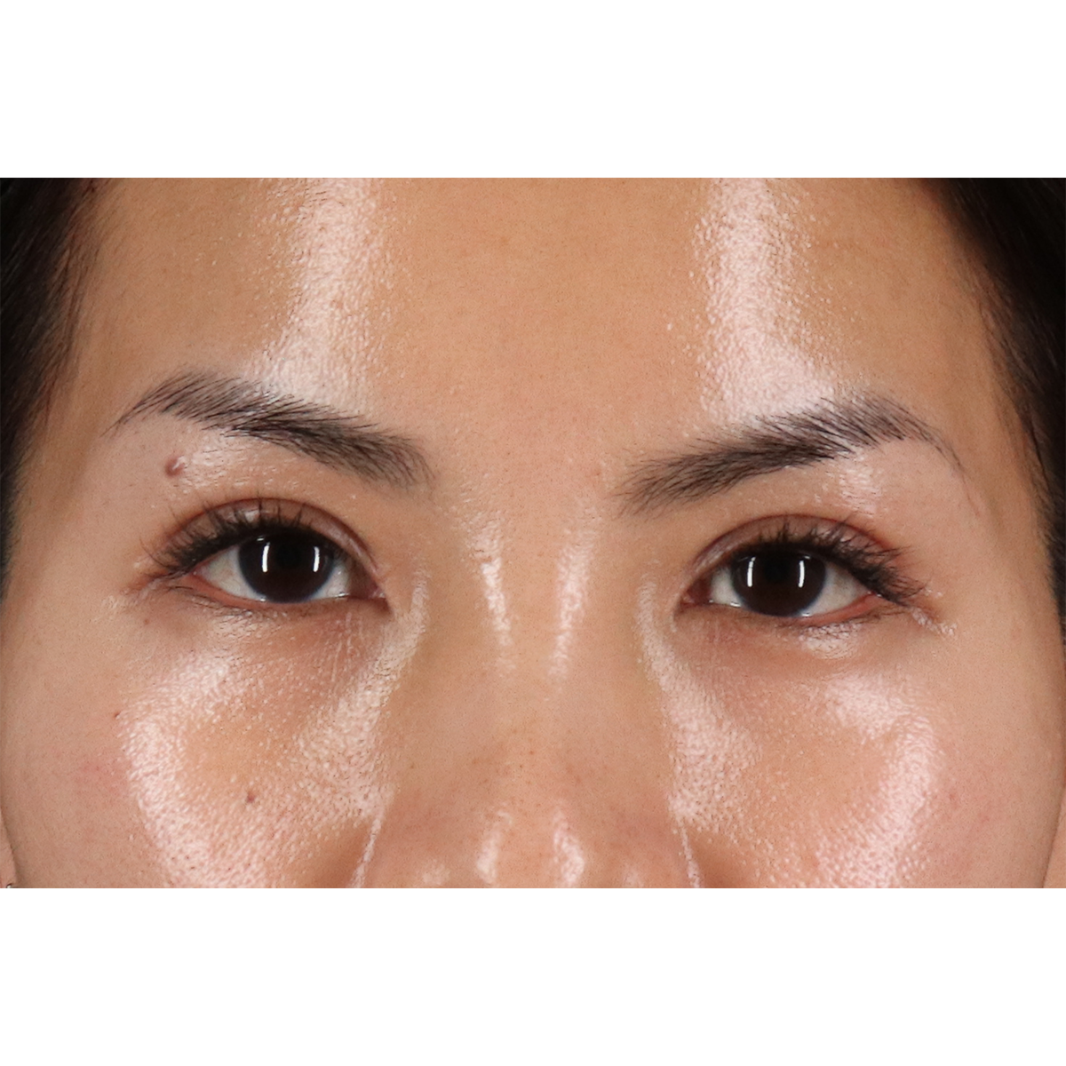 Blepharoplasty (Eyelid Surgery) Before & After Patient #10782