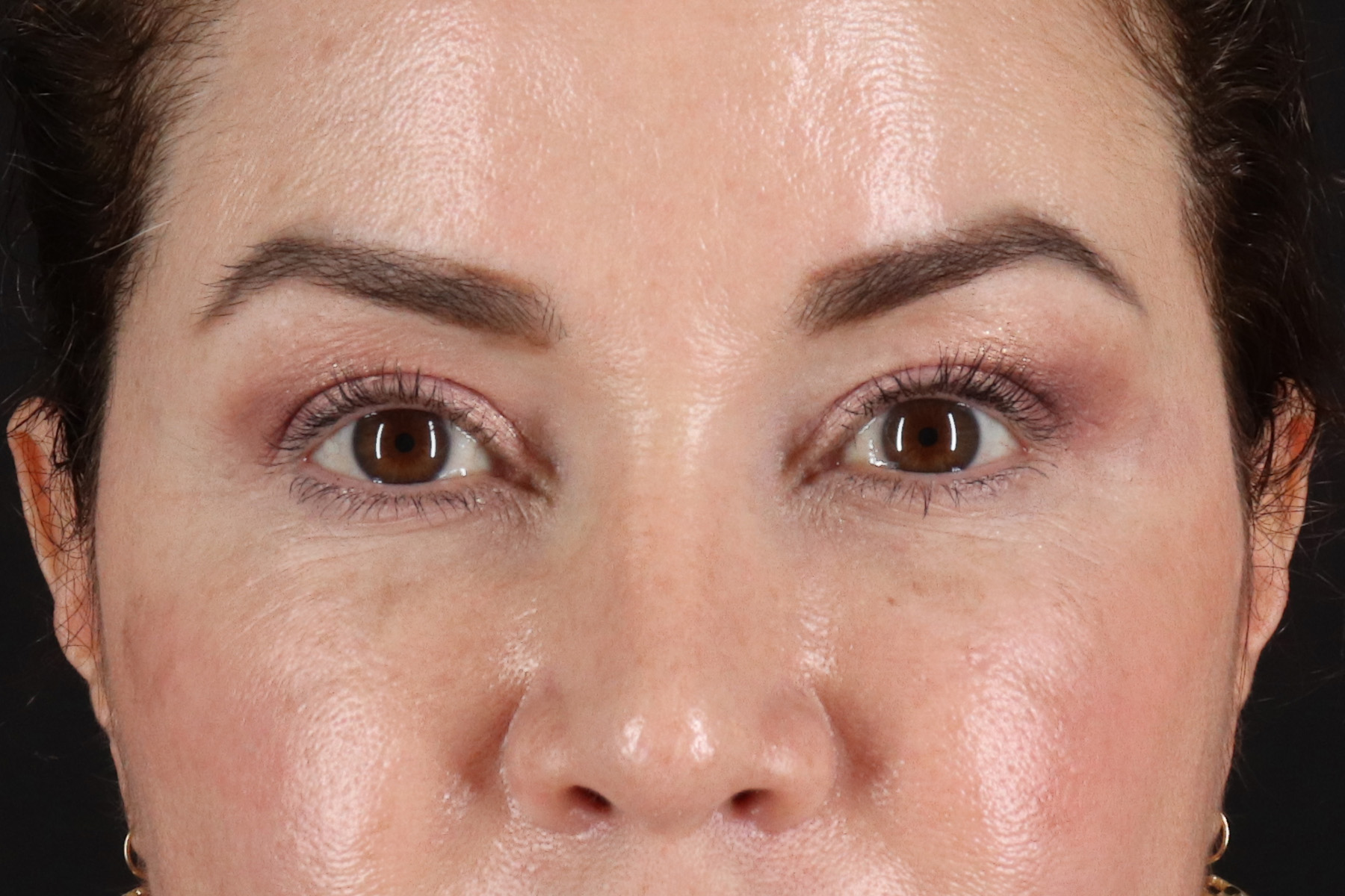 Rhinoplasty Before & After Patient #12656