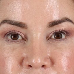 Upper Blepharoplasty Before & After Patient #12073