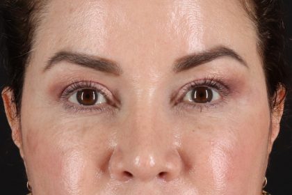 Upper Blepharoplasty Before & After Patient #12073