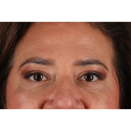 Blepharoplasty (Eyelid Surgery) Before & After Patient #11125