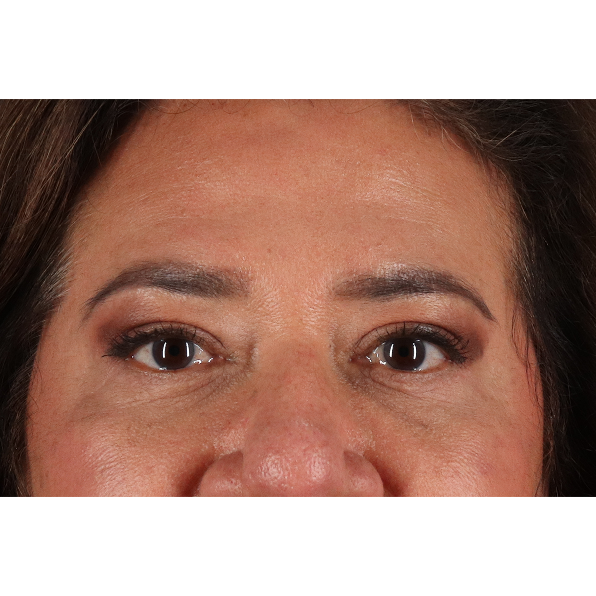 Blepharoplasty (Eyelid Surgery) Before & After Patient #11125