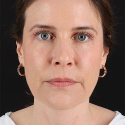 Fat Grafting To The Face Before & After Patient #11817