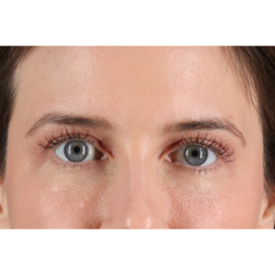 Blepharoplasty (Eyelid Surgery) Before & After Patient #11517