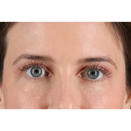 Blepharoplasty (Eyelid Surgery) Before & After Patient #11517