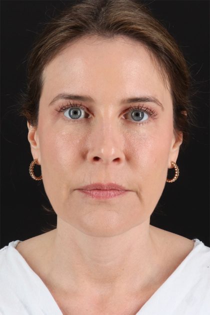 Fat Grafting To The Face Before & After Patient #11817