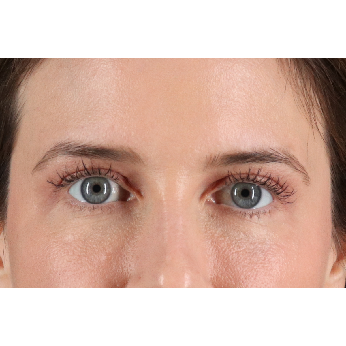 Blepharoplasty (Eyelid Surgery) Before & After Patient #11517