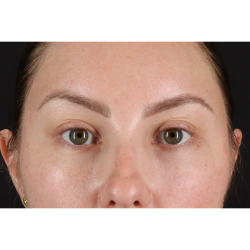 Brow Lift Before & After Patient #11657