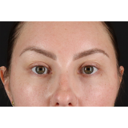Brow Lift Before & After Patient #11657