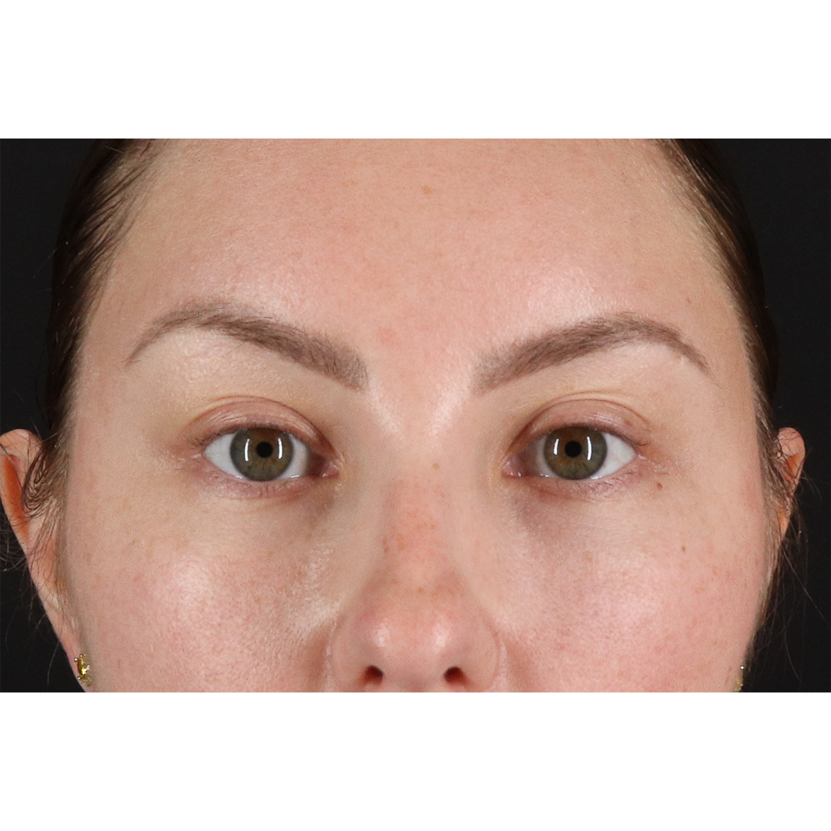 Brow Lift Before & After Patient #11657
