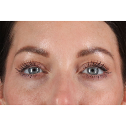 Blepharoplasty (Eyelid Surgery) Before & After Patient #11026