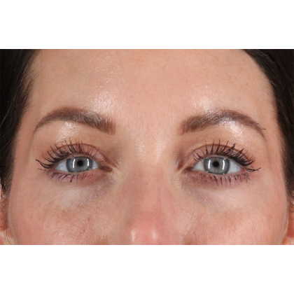 Blepharoplasty (Eyelid Surgery) Before & After Patient #11026