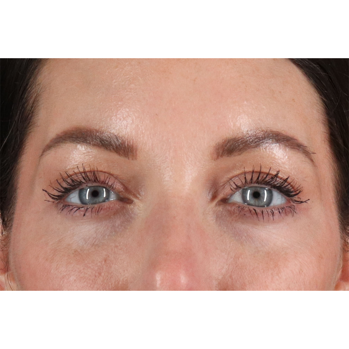 Blepharoplasty (Eyelid Surgery) Before & After Patient #11026