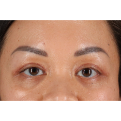 Blepharoplasty (Eyelid Surgery) Before & After Patient #11037