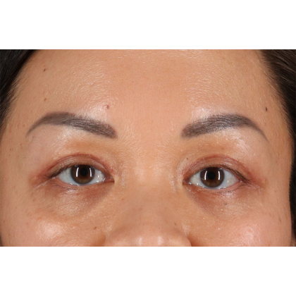 Blepharoplasty (Eyelid Surgery) Before & After Patient #11037