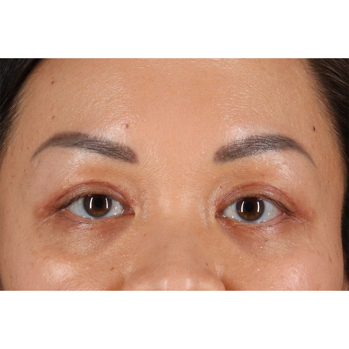 Blepharoplasty (Eyelid Surgery) Before & After Patient #11037
