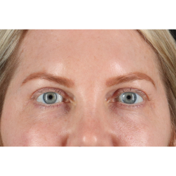 Blepharoplasty (Eyelid Surgery) Before & After Patient #11158