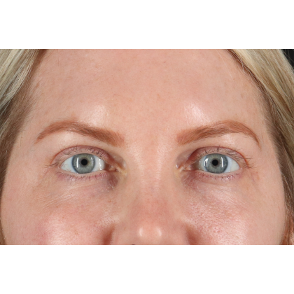 Blepharoplasty (Eyelid Surgery) Before & After Patient #11158
