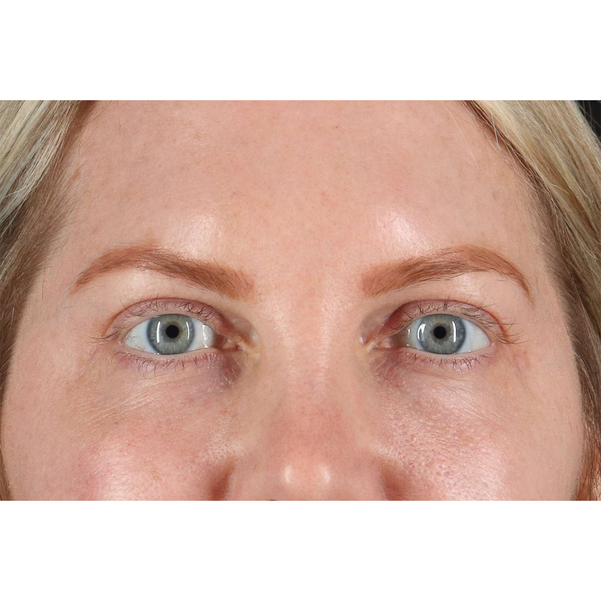 Blepharoplasty (Eyelid Surgery) Before & After Patient #11158