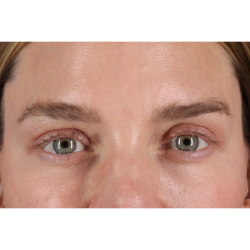 Blepharoplasty (Eyelid Surgery) Before & After Patient #11541