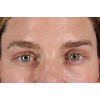 Blepharoplasty (Eyelid Surgery) Before & After Patient #11541