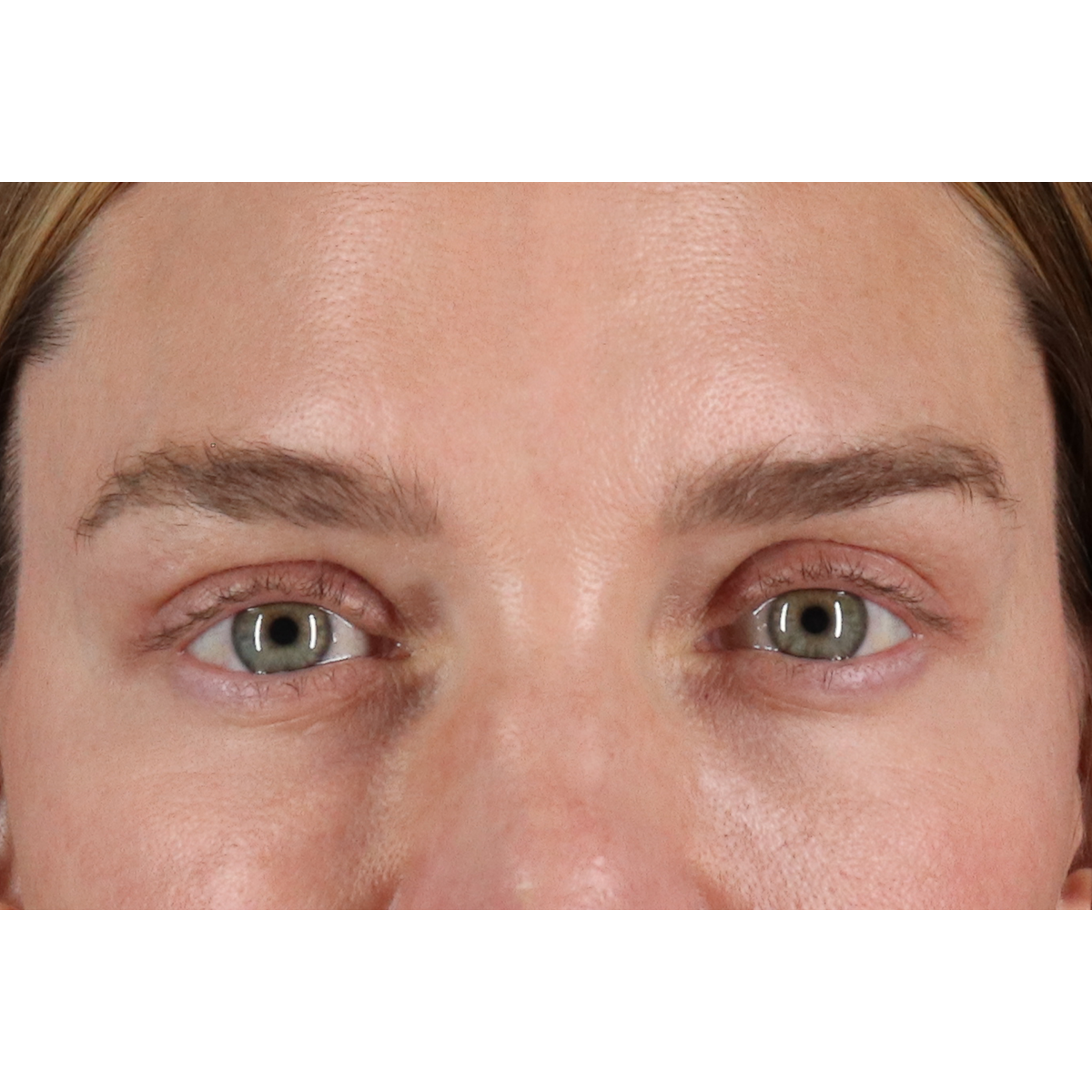 Blepharoplasty (Eyelid Surgery) Before & After Patient #11541