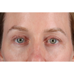 Blepharoplasty (Eyelid Surgery) Before & After Patient #11883