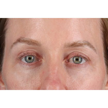 Blepharoplasty (Eyelid Surgery) Before & After Patient #11883