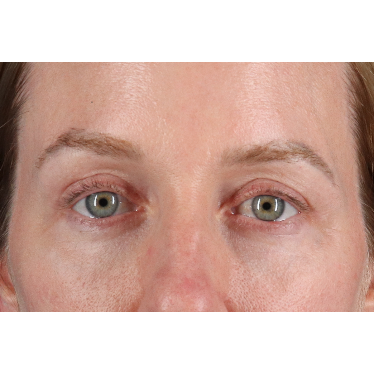 Blepharoplasty (Eyelid Surgery) Before & After Patient #11883