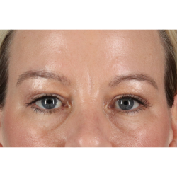 Blepharoplasty (Eyelid Surgery) Before & After Patient #11048