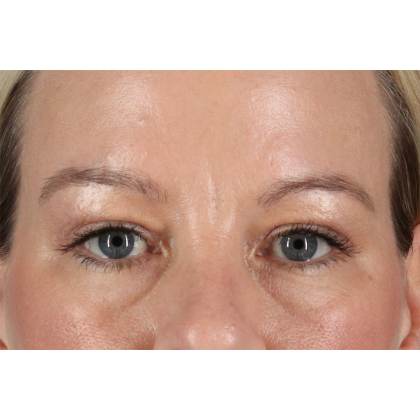 Blepharoplasty (Eyelid Surgery) Before & After Patient #11048