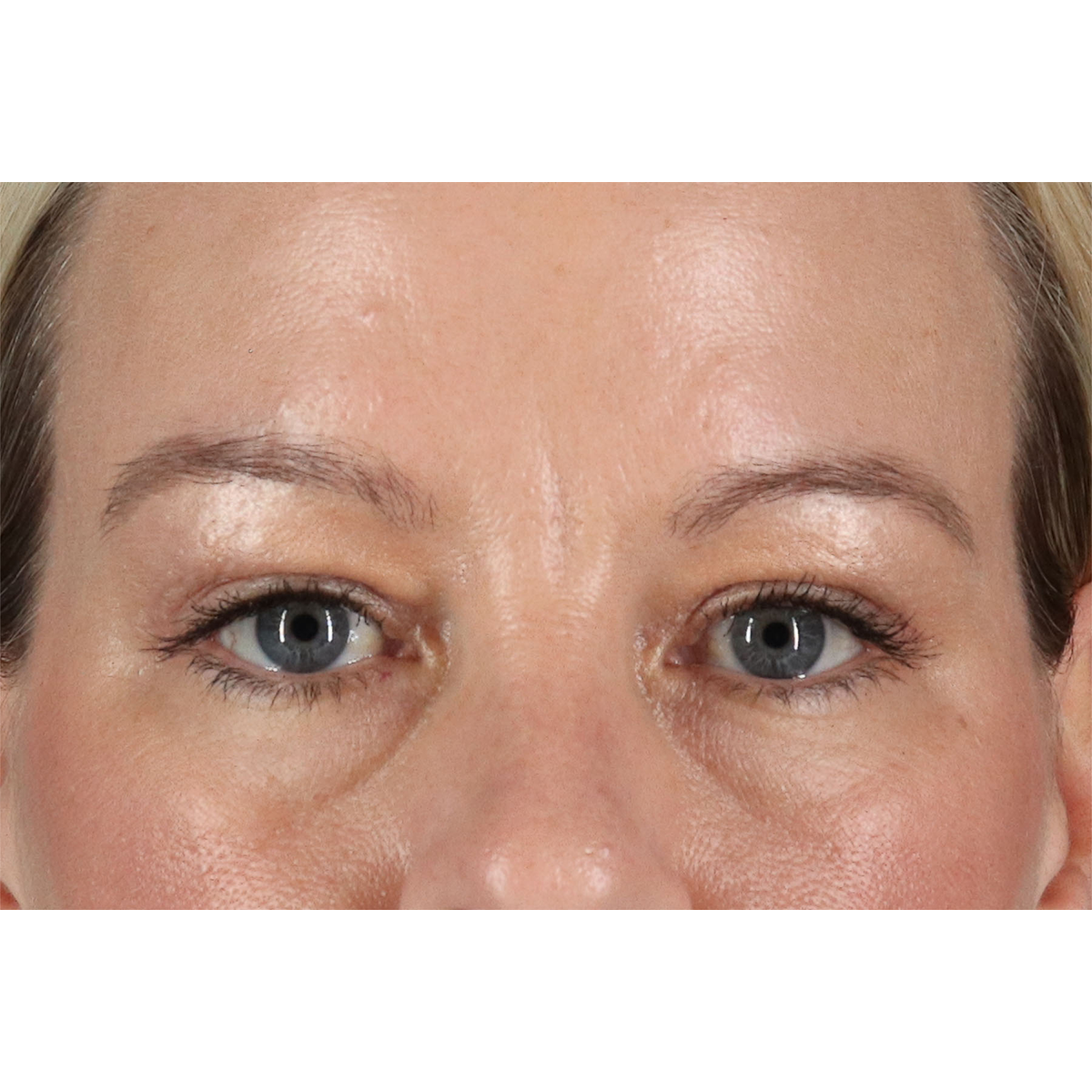 Blepharoplasty (Eyelid Surgery) Before & After Patient #11048