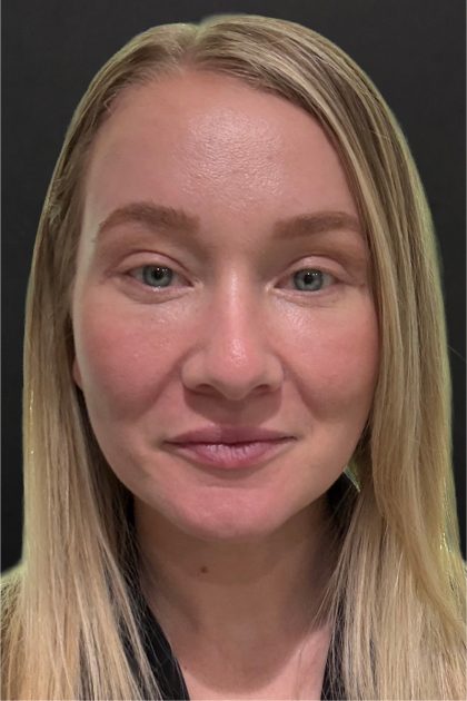 Fat Grafting To The Face Before & After Patient #11812