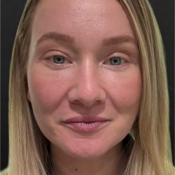CO2 Laser Before & After Patient #11415