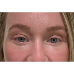 Blepharoplasty (Eyelid Surgery) Before & After Patient #11679