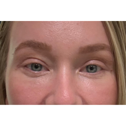 Blepharoplasty (Eyelid Surgery) Before & After Patient #11679