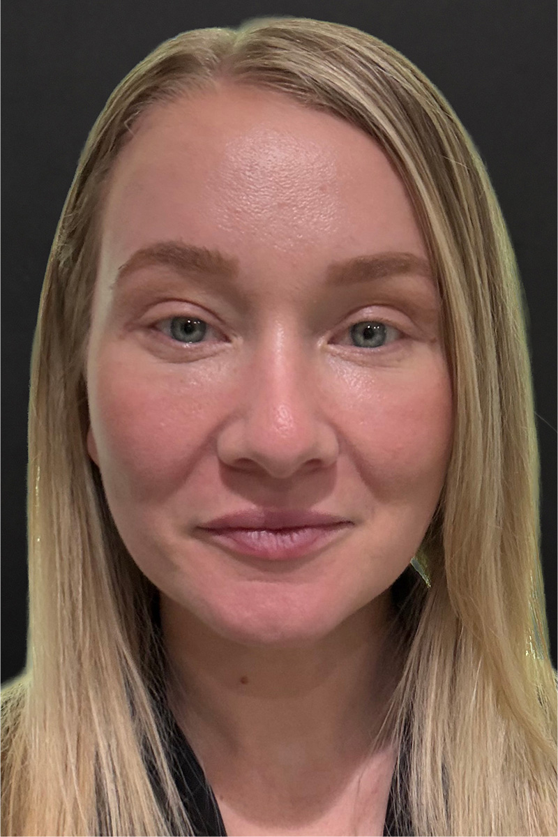 CO2 Laser Before & After Patient #11415