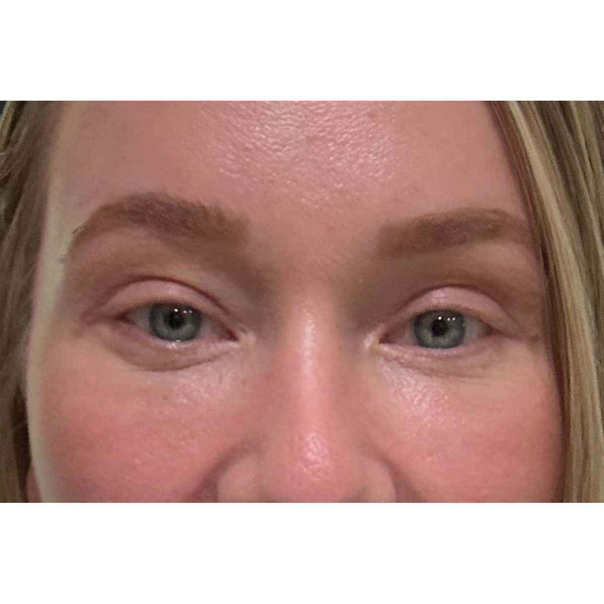 Blepharoplasty (Eyelid Surgery) Before & After Patient #11679