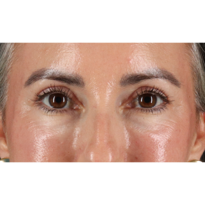 Blepharoplasty (Eyelid Surgery) Before & After Patient #11282