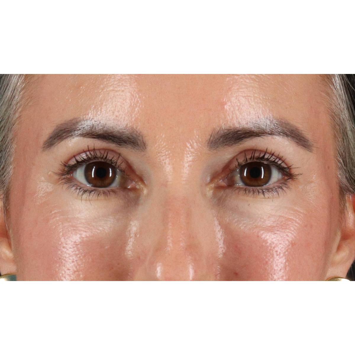 Blepharoplasty (Eyelid Surgery) Before & After Patient #11282