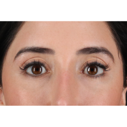 Blepharoplasty (Eyelid Surgery) Before & After Patient #11668