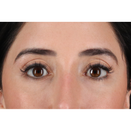 Blepharoplasty (Eyelid Surgery) Before & After Patient #11668