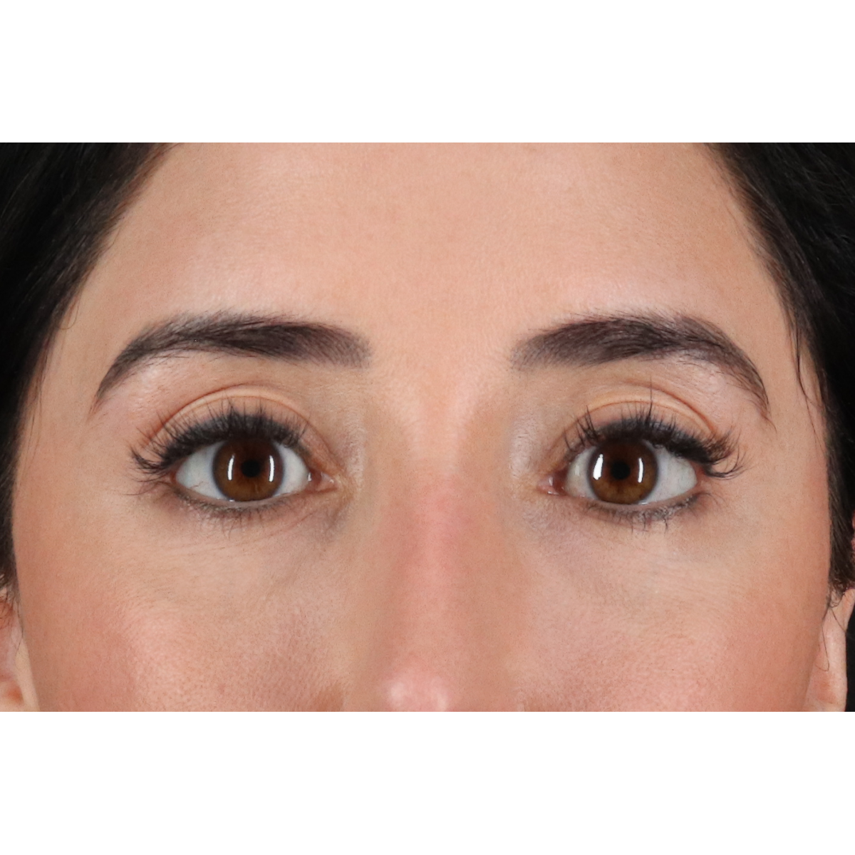 Blepharoplasty (Eyelid Surgery) Before & After Patient #11668